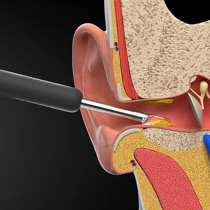 Otoscópio Wireless com Limpeza de Ouvido