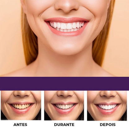 Gel Roxo Branqueador de Dentes